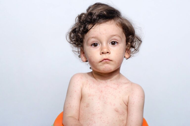 portrait of a cute sick baby boy. adorable upset child with spots on his face and body form illness, mosquito bites, roseola, rubella, measles.
