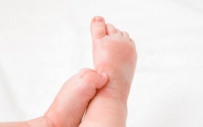 infant legs with red dry skin. suffering from allergy of milk formula or other food. closeup.