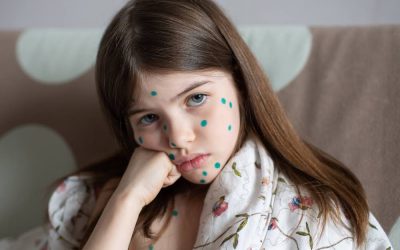 a little  girl with chickenpox